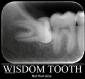 wisdom-tooth.jpg