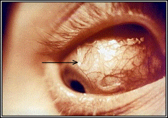eye-filariasis.gif