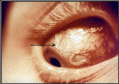eye-filariasis.gif