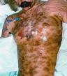 toxic-epidermal-necrolysis-syndrome3.jpg