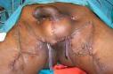 scrotum-cysts-after-surgeryjpg