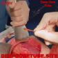 doctor-removing-chicken-bone-that-pierced-a-patients-intestine-up-360.jpg
