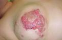 breast-rash2.jpg