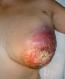 breast-rash5.jpg
