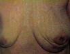 festered-breasts008.jpg