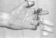 festered-limbs-feet-fingers014.jpg