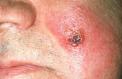 herpes-simplex-cutaneous-10.jpg