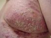 festered-skin-disease005.jpg