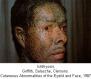 festered-skin-disease012.jpg