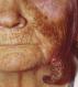 festered-skin-disease020.jpg