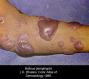 festered-skin-disease037.jpg
