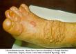 festered-skin-disease060.jpg