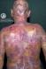 festered-skin-disease108.jpg