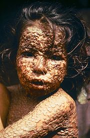 180px-child-with-smallpox-bangladesh.jpg