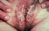 genital-warts-female.jpg