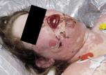 toxic-epidermal-necrolysis-syndrome.jpg