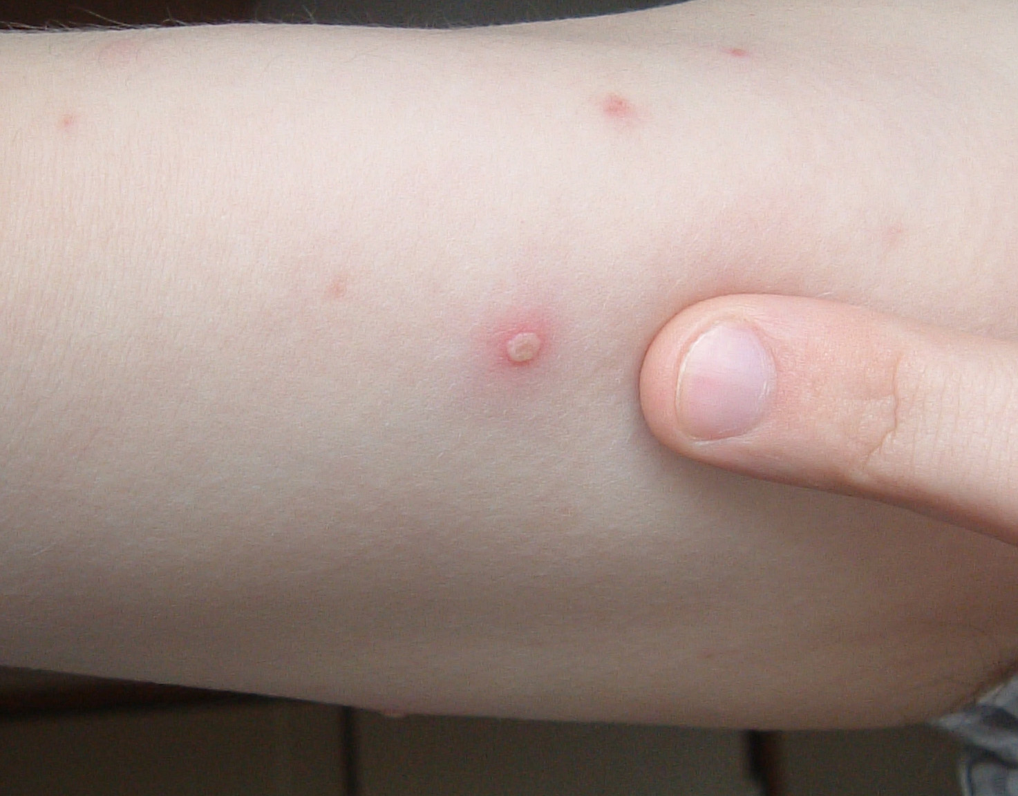 chickenpox-blister-2006.01.06.jpg