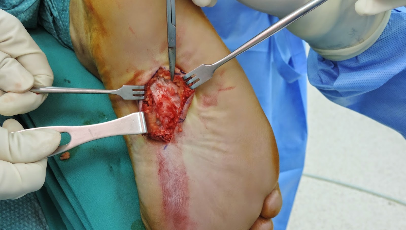 plantar-fibromatosis.jpg