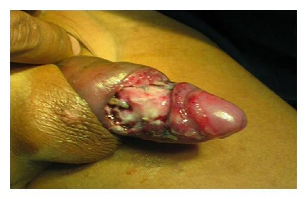 penis.jpg