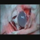 brain-cyst-removal-691ce8-008jpg
