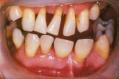 long-term-gum-disease-causes-the-gums-to-pull-away-from-the-teeth.jpg