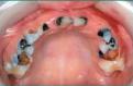 severe-decay-affecting-the-deciduous-dentition.-age-6-years.jpg
