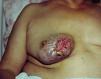 breast-rash6.jpg