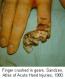 festered-limbs-feet-fingers081.jpg