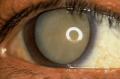 cataractmature.jpg.w560h370.jpg