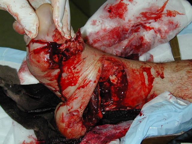 degloving-right-foot.jpg