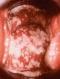 candidiasis-vaginal-classic.jpg