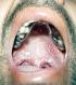 oral-candidiasis.jpg