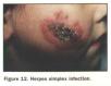 festered-herpes025.jpg