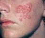 herpes-simplex-cutaneous-12.jpg