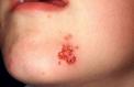 herpes-simplex-cutaneous-13.jpg