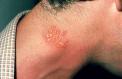 herpes-simplex-cutaneous-25.jpg