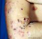 festered-skin-disease003.jpg