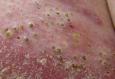 festered-skin-disease006.jpg