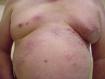 festered-skin-disease007.jpg