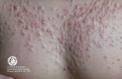 festered-skin-disease008.jpg