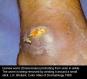 festered-skin-disease030.jpg