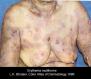 festered-skin-disease032.jpg