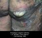 festered-skin-disease035.jpg