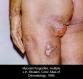 festered-skin-disease049.jpg