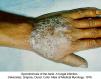 festered-skin-disease058.jpg