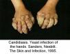 festered-skin-disease078.jpg