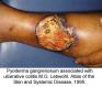 festered-skin-disease093.jpg