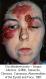 festered-skin-disease103.jpg