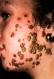 festered-skin-disease111.jpg