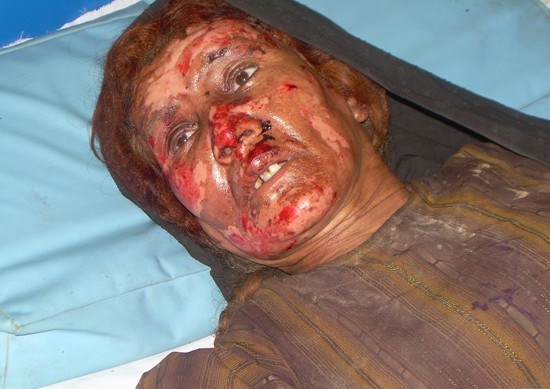 bala-baluk-wounded1.jpg